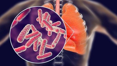 Kakšni so znaki tuberkuloze, ene najpogostejših in najsmrtonosnejših nalezljivih bolezni na svetu, ki je še vedno prisotna tudi v Sloveniji? 