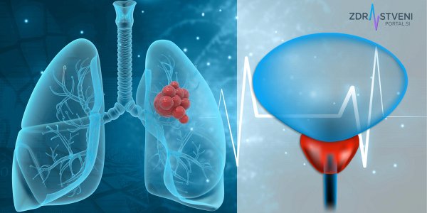 Rak prostate in rak pljuč – poznavanje simptomov in uvedba presejanja sta ključna za zgodnejšo prepoznavo bolezni, za pravočasni začetek zdravljenja in za zmanjšanje bolezenskega bremena