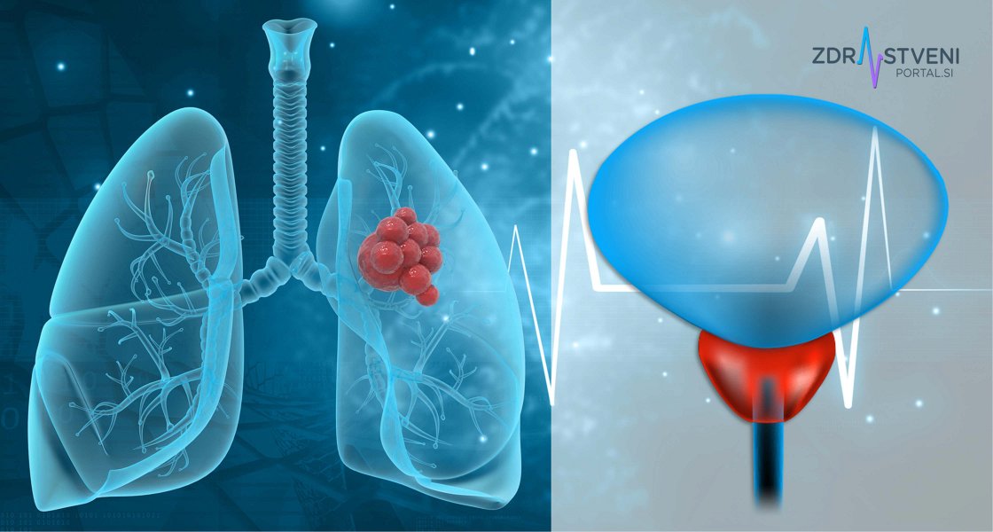 Rak prostate in rak pljuč – poznavanje simptomov in uvedba presejanja sta ključna za zgodnejšo prepoznavo bolezni, za pravočasni začetek zdravljenja in za zmanjšanje bolezenskega bremena