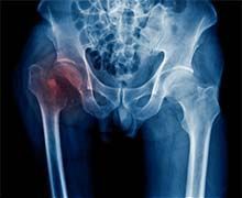 osteoporoza zlom kolka