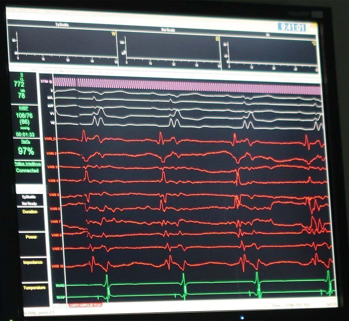 zdravljenje motenj srčnega ritma z elektroporacijo