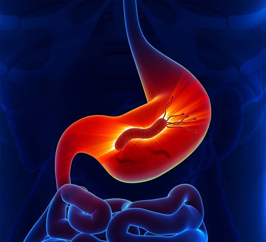 rak želodca_presejalno testiranje in zdravljenje okužbe s H.pylori