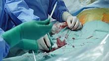 Implantacija aortne zaklopke brez odpiranja prsnega koša