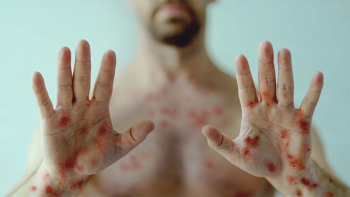 opičje koze_mpox_preprečitev virusne okužbe
