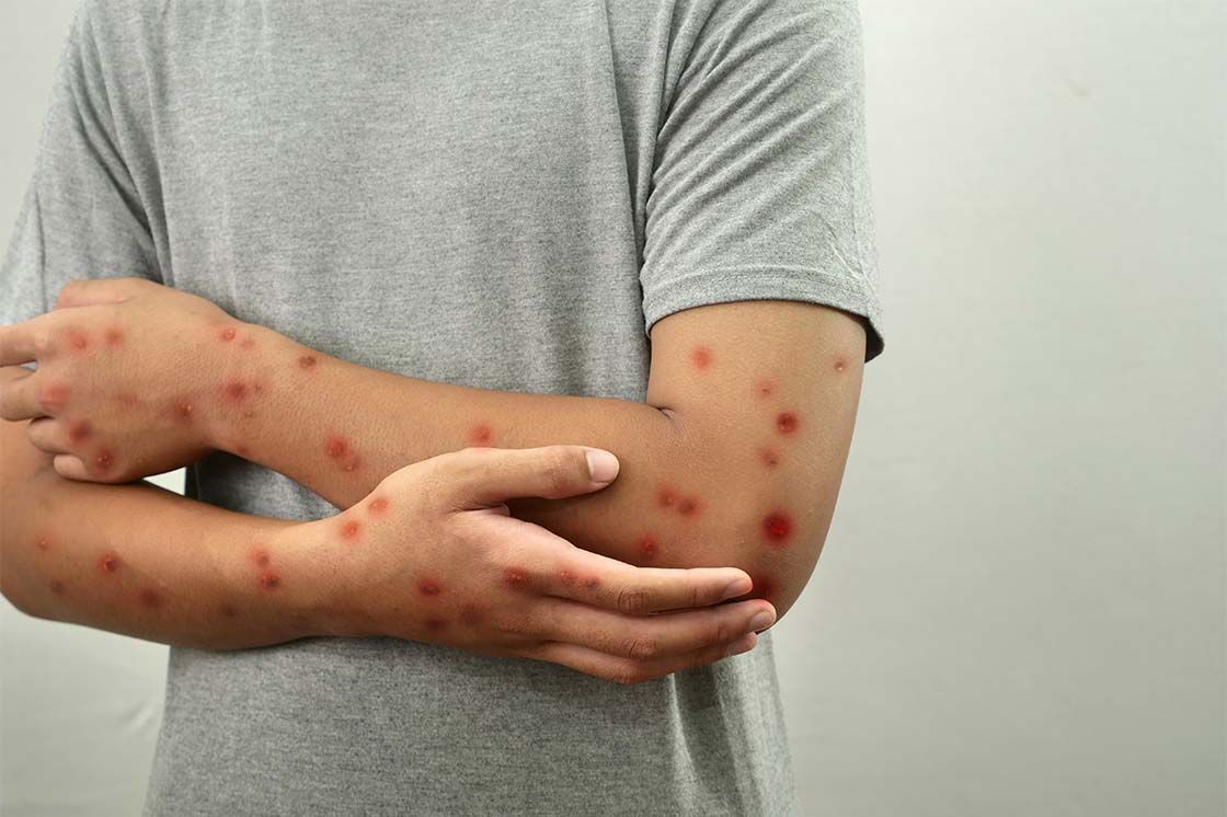 opičje koze_mpox_znaki in ukrepanje