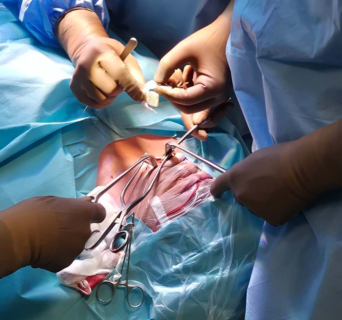 Kirurško zdravljenje obstruktivne spalne apneje - operacija