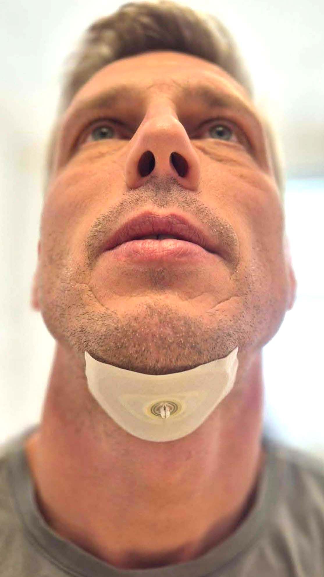 Kirurško zdravljenje obstruktivne spalne apneje - pacient