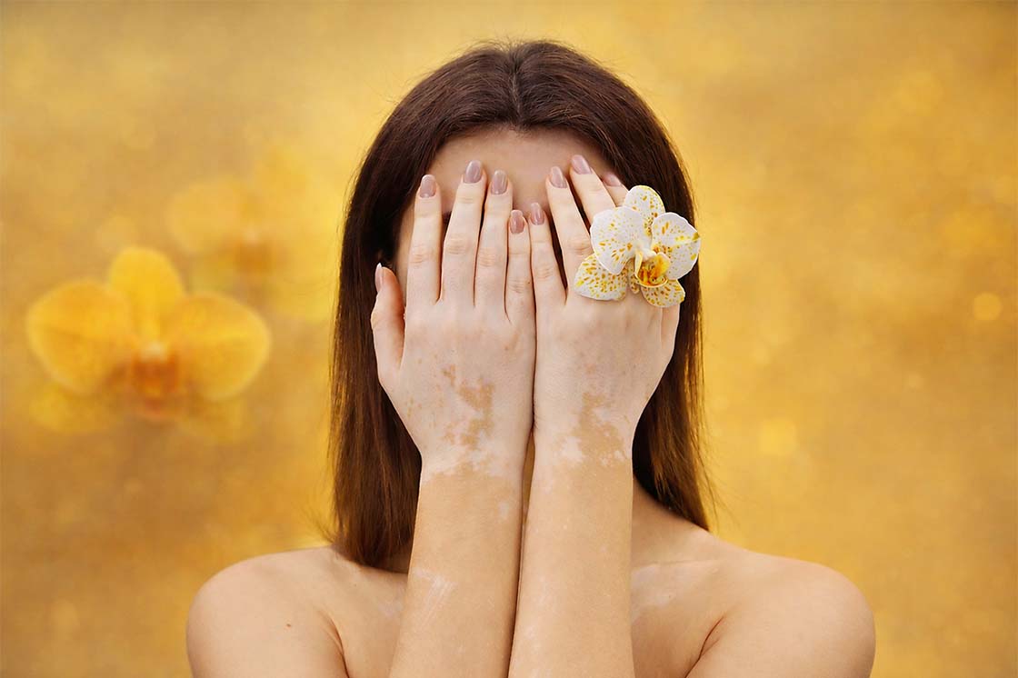 Vitiligo upanje fototerapija