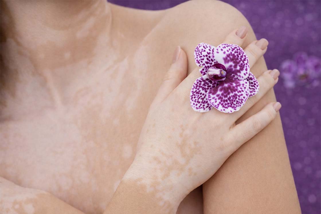 vitiligo zdravljenje